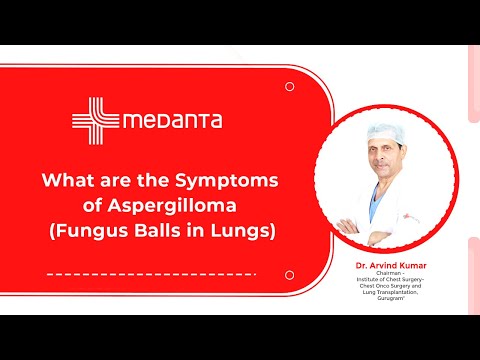  What are the Symptoms of Aspergilloma (Fungus Balls in Lungs)? 